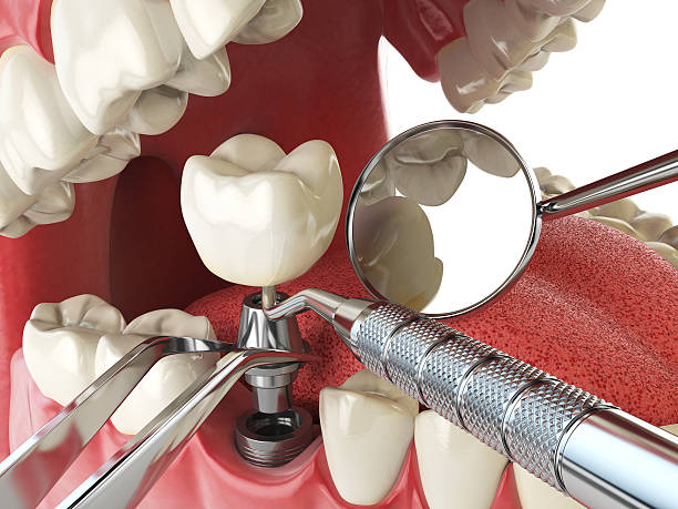 Tooth Infection Emergency Dentist in LA